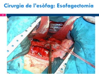 Cirurgia de l’esòfag: Esofagectomia
65

 
