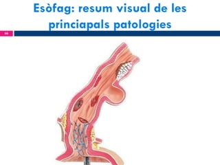 Esòfag: resum visual de les
princiapals patologies
66

 
