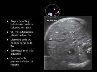 Ao
VCI
E CV
H
VU
⚫ Ao por delante y
lado izquierdo de la
columna vertebral
⚫ VCI más adelantada
y hacia la derecha
⚫ Diámetro de la VCI
no superior al de la
Ao
⚫ Estómago en el lado
izquierdo
⚫ Comprobar la
presencia de ductus
venoso
Abdomen
 