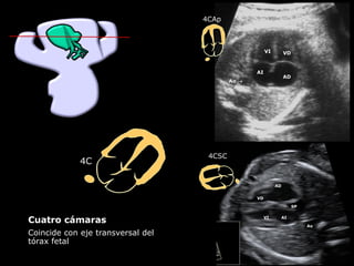 Cuatro cámaras
Coincide con eje transversal del
tórax fetal
VI VD
AD
AI
Ao →
VI
VD
AD
AI
Ao
SP
4CSC
4CAp
4C
 