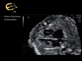 4C
▪ Ritmo y frecuencia
▪ Contractilidad
 