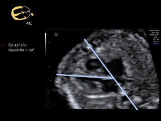 4C
dad
▪ Eje 45º a la
izquierda +- 20º
 