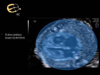 4C
▪ El área cardiaca
ocupa 1/3 del tórax
 