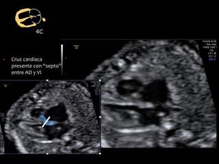 4C
▪ Cruz cardiaca
presente con “septo”
entre AD y VI
 