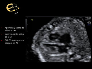 4C
▪ Apertura y cierre de
válvulas AV
▪ Inserción más apical
de la VT
▪ CIA OS con septum
primum en AI
 