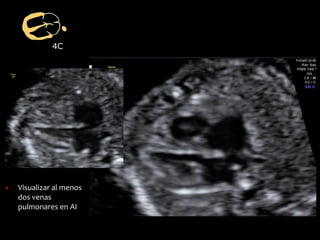 4C
▪ Visualizar al menos
dos venas
pulmonares en AI
 
