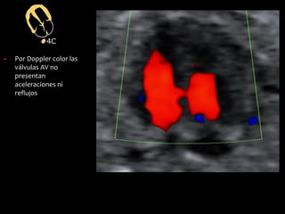 4C
▪ Por Doppler color las
válvulas AV no
presentan
aceleraciones ni
reflujos
 