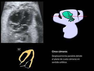 VI
VD
AD
AI
Ao
*
*
*
AoD
VA
D
I
5C
Cinco cámaras
Desplazamiento paralelo delsde
el plano de cuato cámaras en
sentido cefálico
 