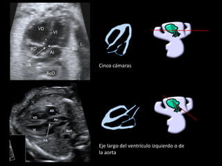 Eje largo del ventrículo izquierdo o de
la aorta
VI
VD
Ao
VA
AoD
AD
VI
VD
AD
AI
Ao
*
**
AoD
VA
D
I
Cinco cámaras
 