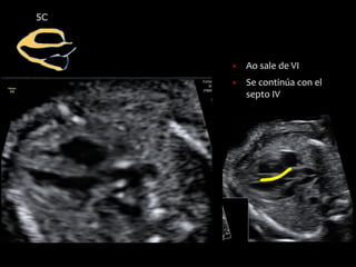 5C
▪ Ao sale de VI
▪ Se continúa con el
septo IV
 