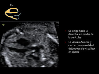 5C
▪ Se dirige hacia la
derecha, en medio de
la aurículas
▪ La válvula Ao abre y
cierra con normalidad,
dejándose de visualizar
en sístole
 