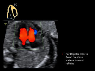 5C
▪ Por Doppler color la
Ao no presenta
aceleraciones ni
reflujos
 