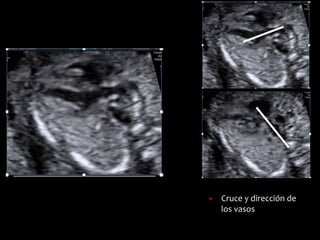 ▪ Cruce y dirección de
los vasos
 