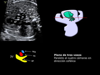 3V
CVAP
Ao
VCS
RDAP
RIAP
Plano de tres vasos
Paralelo al cuatro cámaras en
dirección cefálica
 