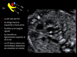 3V
▪ La AP sale del VD
▪ Se dirige hacia la
izquierda y hacia atrás
▪ Se bifurca en ángulo
agudo
▪ Su tamaño es
ligeramente superior al
de la Ao
▪ La VP abre y cierra con
normalidad, dejándose
de visualizar en sístole
 