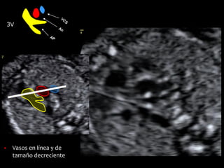 3V
▪ Vasos en línea y de
tamaño decreciente
 