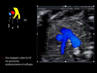 3V
▪ Por doppler color la VP
no presenta
aceleraciones ni reflujos
 