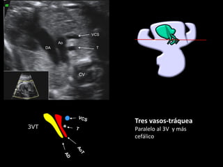 CV
DA
Ao
VCS
T
3VT
Tres vasos-tráquea
Paralelo al 3V y más
cefálico
 