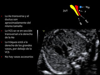 3VT
▪ La Ao transversa y el
ductus son
aproximadamente del
mismo tamaño
▪ La VCS se ve en sección
transversal a la derecha
de la Ao
▪ La tráquea está a la
derecha de los grandes
vasos, por debajo de la
VCS
▪ No hay vasos accesorios
 
