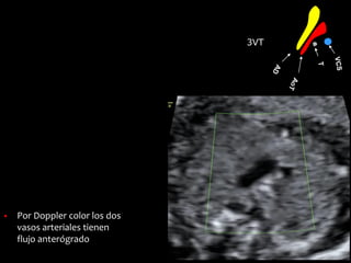3VT
▪ Por Doppler color los dos
vasos arteriales tienen
flujo anterógrado
 