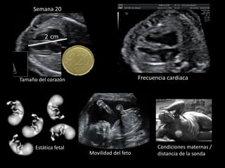 Frecuencia cardiaca
Estática fetal Condiciones maternas /
distancia de la sondaMovilidad del feto
2 cm
Semana 20
Tamaño del corazón
 