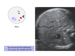 Ao
VCI
E CV
H
VU
• Eje tansversal del abdomen
en la zona de medida del PA
Situs
 