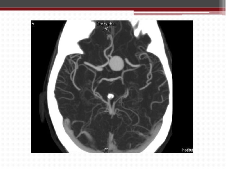 Estudio De Aneurisma Cerebral Mediante Angio Tc