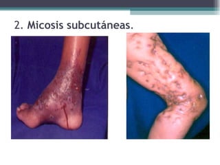   2.  Micosis subcutáneas . 