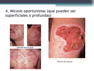 4. Micosis oportunistas (que pueden ser superficiales o profundas) 