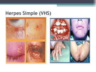 Herpes Simple (VHS) 