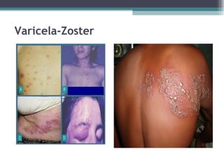 Varicela-Zoster 