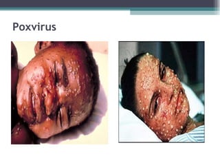 Poxvirus 