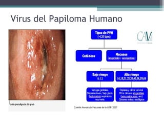 Virus del Papiloma Humano 
