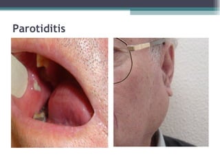 Parotiditis 