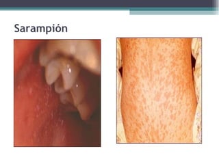 Sarampión 