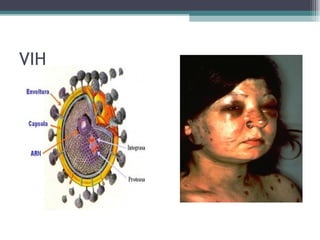 VIH 