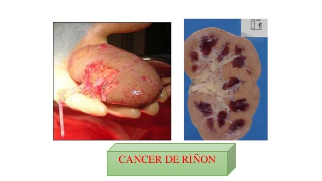 Resultado de imagen para cancer de riñón