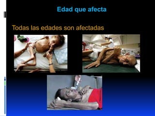 Edad que afecta
Todas las edades son afectadas
 