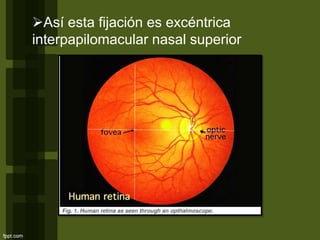 Así esta fijación es excéntrica
interpapilomacular nasal superior
 