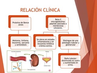 RELACIÓN CLÍNICA
Proteína de Bence
Jones
Mieloma, linfoma,
leucemia, sarcoma
y amiloidosis
Beta-2
microglobulina:
péptido asociado a
membranas
celulares.
Se eleva en estados
inflamatorios y en
leucemia linfática
crónica activa.
Distingue de una
patología tubular y
glomerular
Daño tubular:
disminuida en suero
y aumentada en
orina.
 