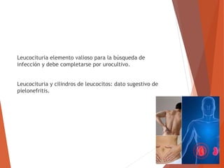 Leucocituria elemento valioso para la búsqueda de
infección y debe completarse por urocultivo.
Leucocituria y cilindros de leucocitos: dato sugestivo de
pielonefritis.
 
