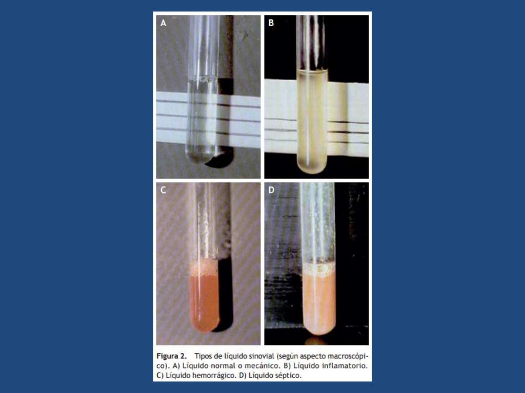 Estudio de liquido sinovial