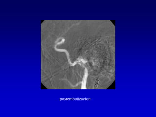 postembolizacion
