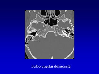 Bulbo yugular dehiscente