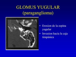 GLOMUS YUGULAR(paraganglioma)Erosion de la espina yugularInvasion hacia la caja timpánica