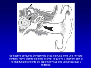 Se explica porque la dehiscencia ósea del CSS crea una “tercera ventana móvil” dentro del oído interno, lo que va a interferir con el normal funcionamiento del laberinto y sus dos ventanas: oval y redonda