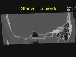 Stenver Izquierdo