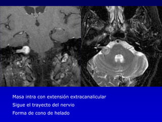 Masa intra con extensión extracanalicularSigue el trayecto del nervioForma de cono de helado