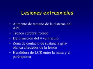 Lesiones extraaxialesAumento de tamaño de la cisterna del APCTronco cerebral rotadoDeformación del 4 ventrículoZona de contacto de sustancia gris-blanca alrededor de la lesiónHendidura de LCR entre la masa y el parénquima