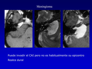 MeningiomaPuede invadir el CAI pero no es habitualmente su epicentroRealce dural